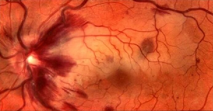 Retina and vision recovery vessels